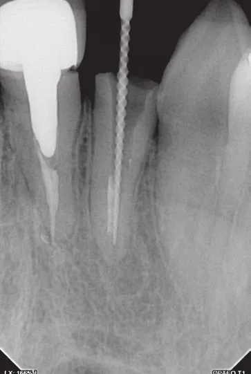 Endodontie, lime en place