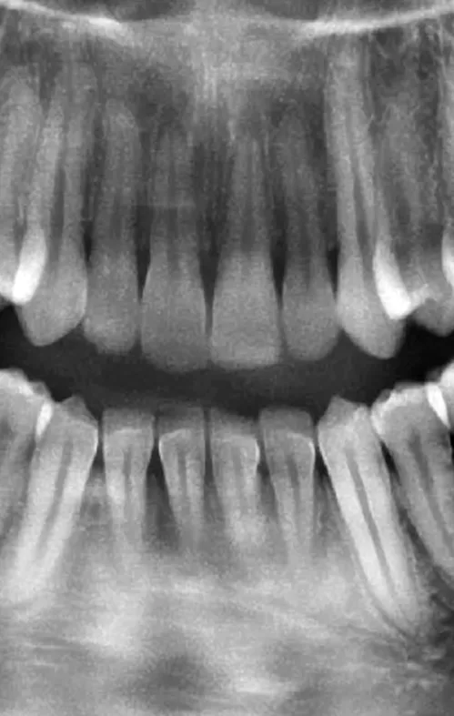 Reconstruction S-Pan