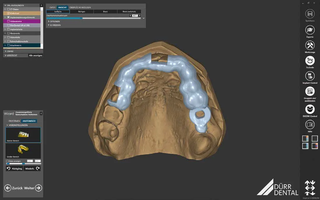 VistaSoft Implant & Guide : planification