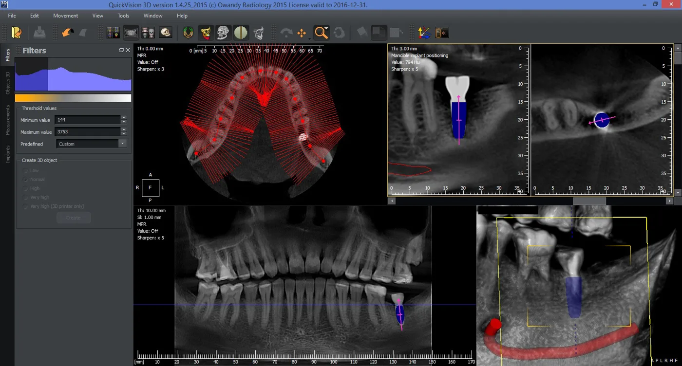 Planification d'implant dans QuickVision 3D